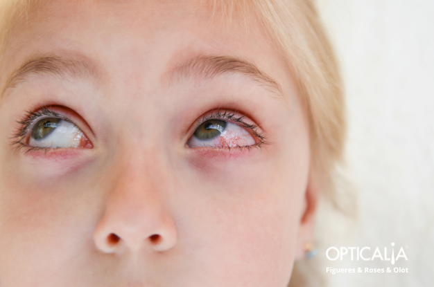 Imagen de una mujer con ojos rojos por alergia ocular